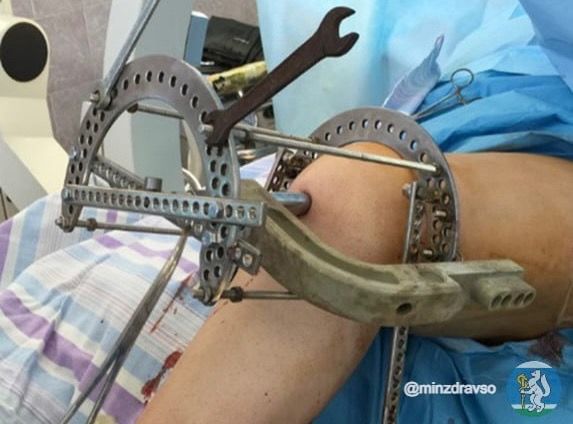 Прорыв в ортопедии: на Урале разработали метод лечения переломов у пациентов с протезами